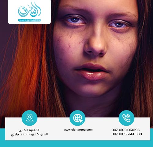 أعراض إدمان مخدر الشعر