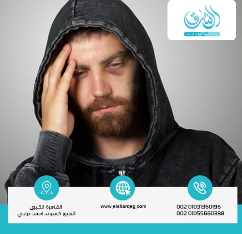 ما هي أعراض انسحاب الحشيش