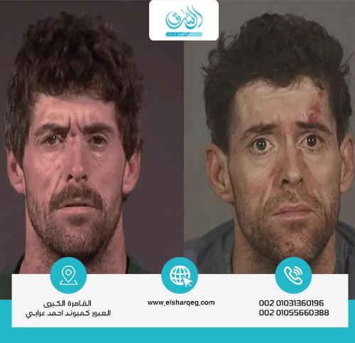 أعراض إدمان مخدر سيكلورفين (Cyclorphine)